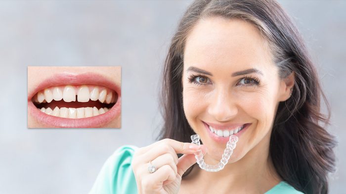 Fix Front Teeth Gap in Houston, Tx | How to fix gap teeth | Teeth Spacing Treatment