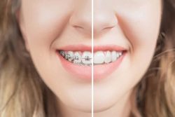 Average Cost of Braces: Age, Type, Insurance, Other Factors