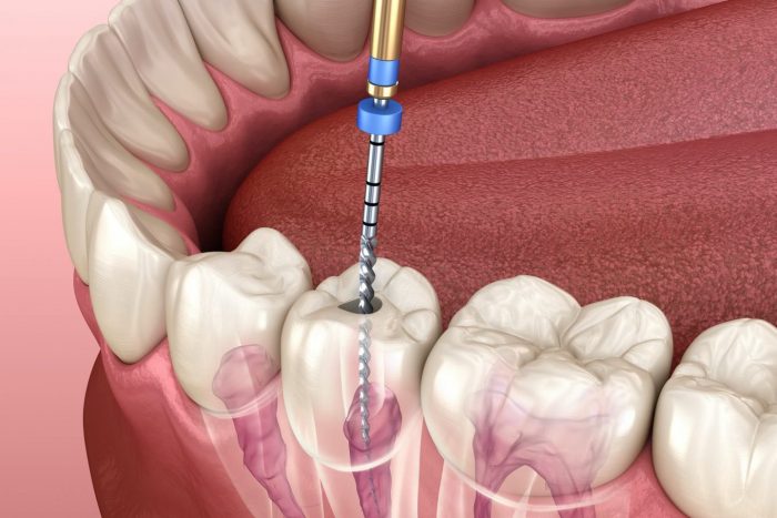 Slide show: Root canal treatment