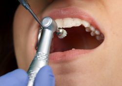 Disadvantages and Advantages of Deep Cleaning Teeth