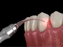 Root Canal: What Is It, Diagnosis, Treatment