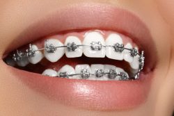 Average Cost of Braces: Age, Type, Insurance, Other Factors |How Much Are Braces With Insurance?