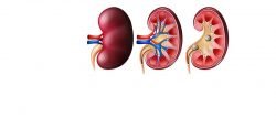 Kidney Stones- What One Need To Know?