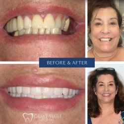 Best Teeth Whitening Port St Lucie – Great Smile Dental
