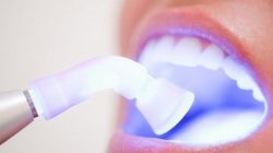 Teeth Whitening at Sabka Dentist