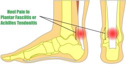 Whichever am I suffering from between plantar fasciitis and achilles tendonitis?
