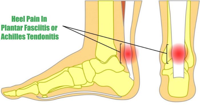 Whichever am I suffering from between plantar fasciitis and achilles tendonitis?