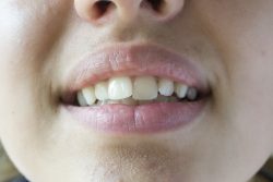 Fixing Crooked Teeth: Veneers vs. Invisalign