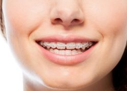 Overbite Before And After Braces | How to Fix an Overbite with Braces