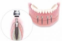 Cost of Dental Implants in Houston – Dental Implants in Houston Tx