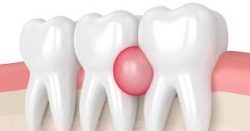 Dental abscess symptoms & treatments – Illnesses & conditions
