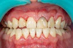 What Are the Different Stages of Periodontal Disease? | Treatment For Periodontal Disease