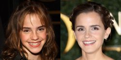 Celebrity Teeth Before And After | Before And After Celebrity Teeth