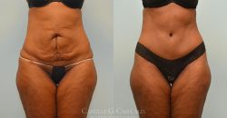 The Clinic For Plastic Surgery – Liposuction Houston TX | Liposuction Near Me | Cosmetic S ...