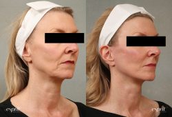 What Is a Neck Lift? | Neck Lift Cosmetic Surgery | Neck Lift Procedure