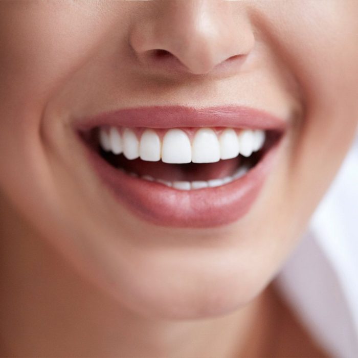 Traditional Veneers Near me |Dental Veneers: Benefits, Procedure, Costs, and Results
