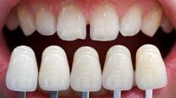 What Are The Different Types of Veneers?