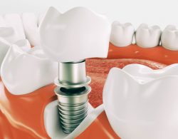 Dental Implants in North Miami – What Are Dental Implants?