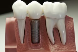 Dental Implants in Surfside, Miami |Dental Implants North Miami Beach FL