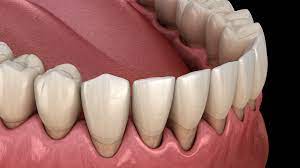 Laser Dentistry For Gum Disease