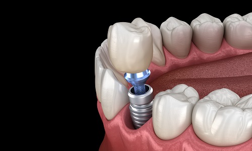 Dental Implants Cost Near Me