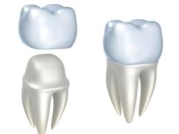 Same-Day Dental Crowns in Houston TX |Cosmetic Crowns Service In Houston