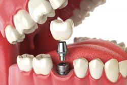 Affordable Dental Implants Near Me |single dental implant treatment at low cost