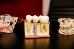Finding The Best Dental Implants Near Me |Best dentist for tooth implant