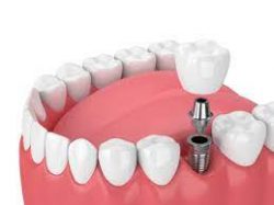 Finding The Best Dental Implants Near Me |Best Dentist for Dental Implants near me