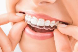 Clear Teeth Aligners, Invisible Braces Cost