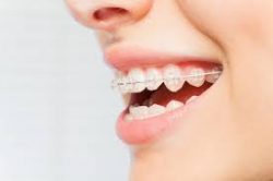 Invisible Braces | How They Work & What They Cost