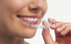 Dental Braces – The Dental Specialists | How Much Do Clear Braces Cost?