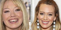 Celebrity Teeth Before And After | Before And After Celebrity Teeth | Celebrity Teeth Before &am ...