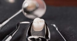 Wisdom Tooth Extraction Near Me – Dentist in Houston