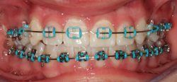 Cute Colors For Braces |How to Pick the Best Braces Color for Your Teeth