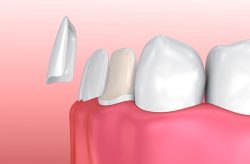 Traditional dental veneers | What Are Dental Veneers