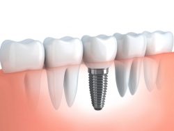 Dental Implants in North Miami