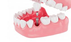Dental Implants Service | Painless Dental Implants