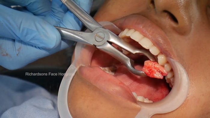 Wisdom tooth Removal