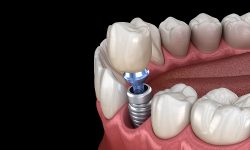 Dental Implants : single dental implant treatment at low cost