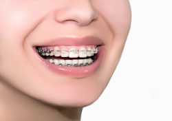 Find Local Braces Dentist Near Me |Should I Get Metal or Clear Braces?