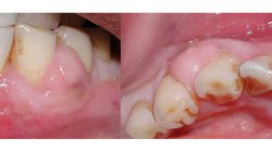 Tooth abscess: MedlinePlus Medical Encyclopedia