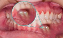 What is an Abscess Tooth | Dental Abscess – StatPearls