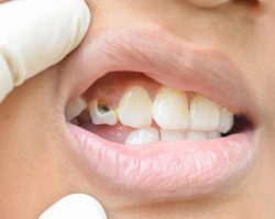 Fix Cavity on Front Tooth | What Causes a Cavity on the Front Tooth