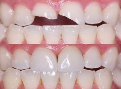 Fix Cavity on Front Tooth | Front Teeth Fillings Before and After – Cumming Dental Smiles