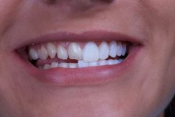 Veneers vs Lumineers: Pros & Cons, Cost, Difference