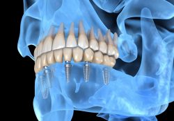 Best Dental Implants Cost – Dentist in Houston, TX