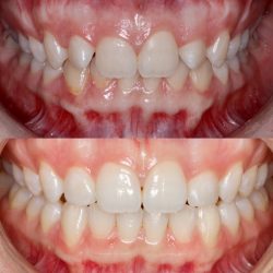 What Are The Benefits Of Dental Bonding?