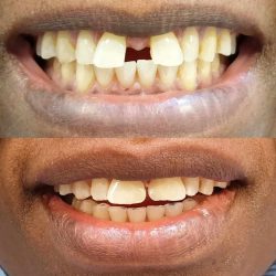 What Are The Benefits Of Teeth Cosmetic Bonding?