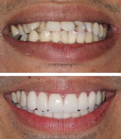 What Are The Different Types of Veneers? | Different types of veneers – Sendhil Dental Clinic